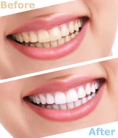 before and after look at professional teeth whitening services offered at Prosthodontic Associates of New Jersey